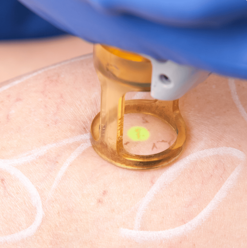 Laser vasculaire vertou